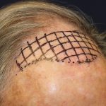 Follicular Unit Extraction Before & After Patient #5099