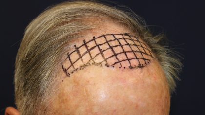 Follicular Unit Extraction Before & After Patient #5099