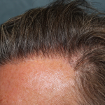 Follicular Unit Extraction Before & After Patient #5106