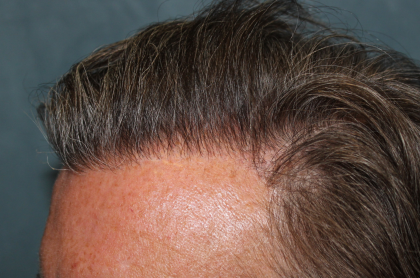 Follicular Unit Extraction Before & After Patient #5106