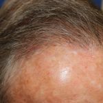 Follicular Unit Extraction Before & After Patient #5099