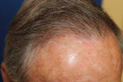 Follicular Unit Extraction Before & After Patient #5099