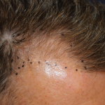Follicular Unit Extraction Before & After Patient #5106