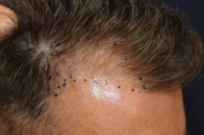 Follicular Unit Extraction Before & After Patient #5106