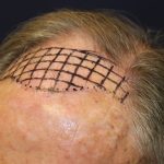 Follicular Unit Extraction Before & After Patient #5099