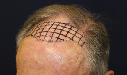 Follicular Unit Extraction Before & After Patient #5099