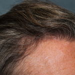 Follicular Unit Extraction Before & After Patient #5106