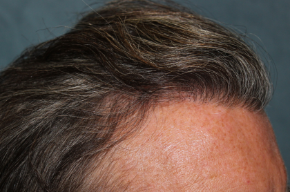 Follicular Unit Extraction Before & After Patient #5106