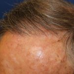 Follicular Unit Extraction Before & After Patient #5099