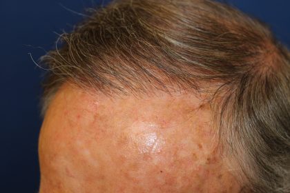Follicular Unit Extraction Before & After Patient #5099