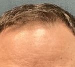 Follicular Unit Extraction Before & After Patient #5225