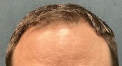 Follicular Unit Extraction Before & After Patient #5225