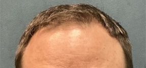 Follicular Unit Extraction Before & After Patient #5225