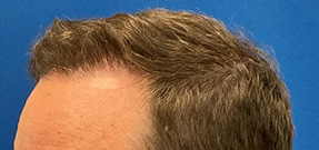 Follicular Unit Extraction Before & After Patient #5225