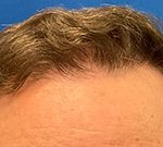 Follicular Unit Extraction Before & After Patient #5225