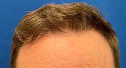 Follicular Unit Extraction Before & After Patient #5225