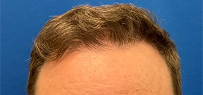 Follicular Unit Extraction Before & After Patient #5225