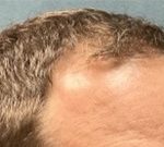 Follicular Unit Extraction Before & After Patient #5225