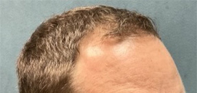 Follicular Unit Extraction Before & After Patient #5225