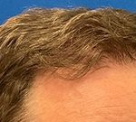 Follicular Unit Extraction Before & After Patient #5225