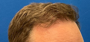 Follicular Unit Extraction Before & After Patient #5225