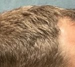 Follicular Unit Extraction Before & After Patient #5225