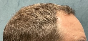 Follicular Unit Extraction Before & After Patient #5225