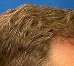 Follicular Unit Extraction Before & After Patient #5225