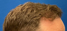 Follicular Unit Extraction Before & After Patient #5225