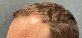 Follicular Unit Extraction Before & After Patient #5225