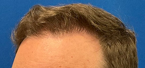 Follicular Unit Extraction Before & After Patient #5225