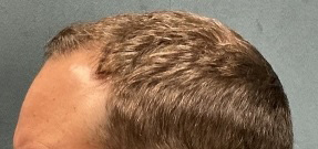 Follicular Unit Extraction Before & After Patient #5225